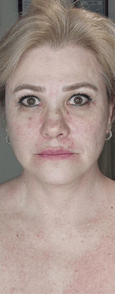 Liposuction after