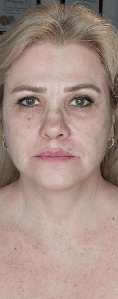 Liposuction before