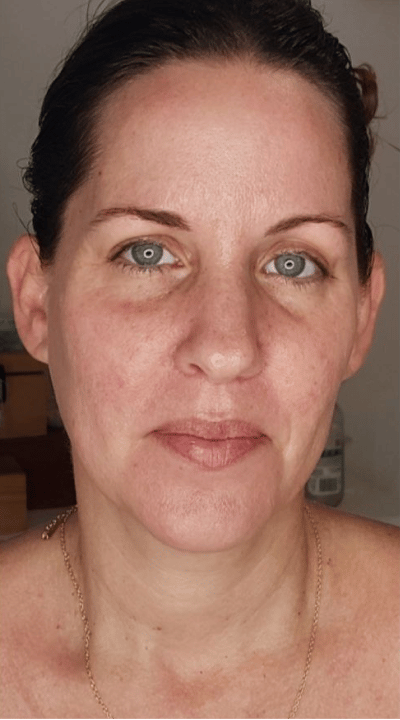 Liposuction after
