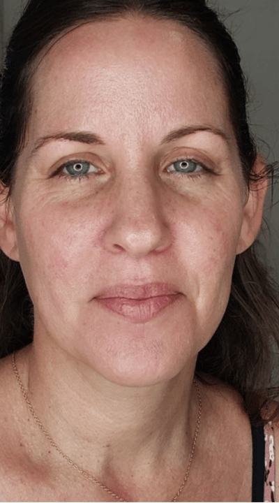 Liposuction before